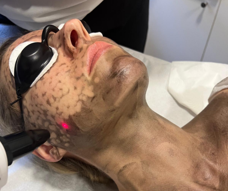 Peeling węglowy 